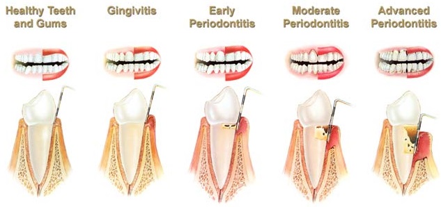 stages-of-gum-disease-baytown-channelview