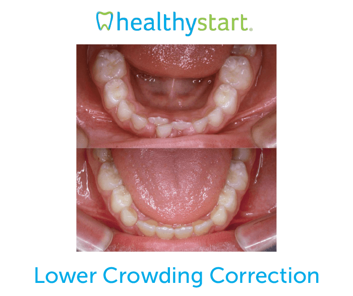 Lower crowding correction