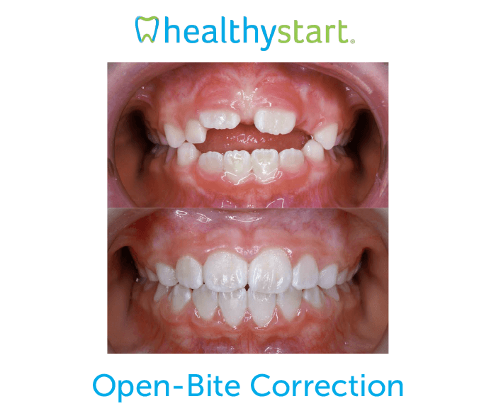 Open-bite correction