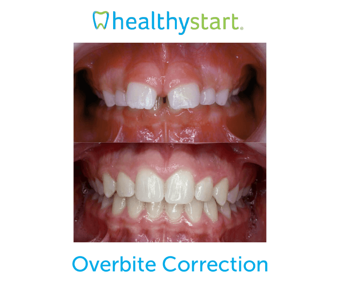 Overbite correction