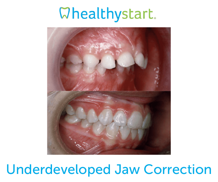 Underdeveloped jaw correction