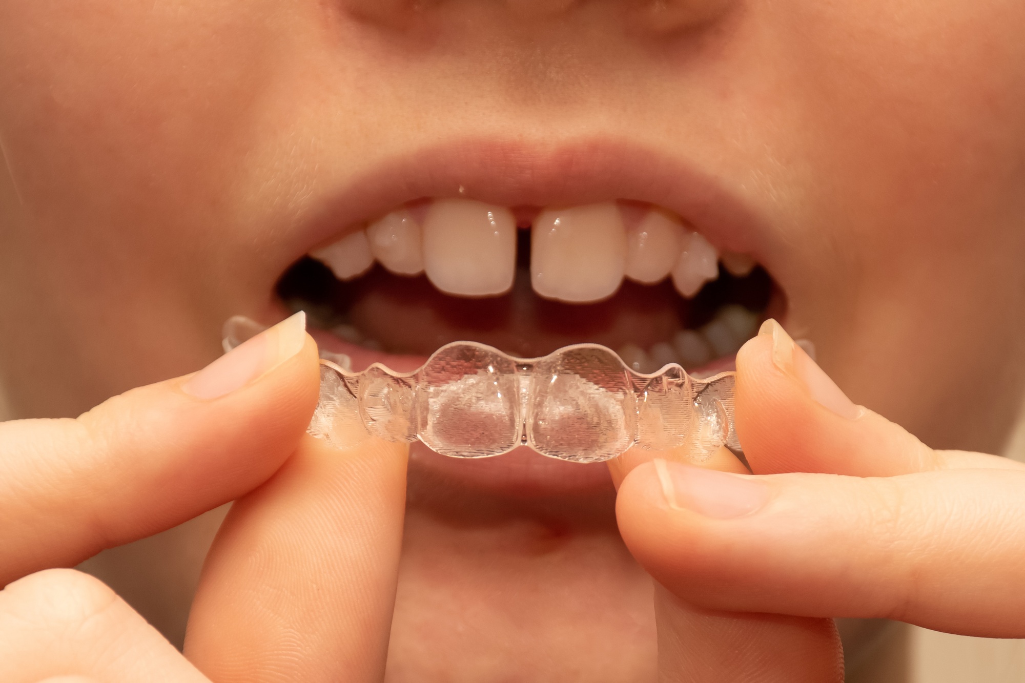 Girl put on Invisalign invisible braces. Bonded attachments on the teeth. Gap teeth