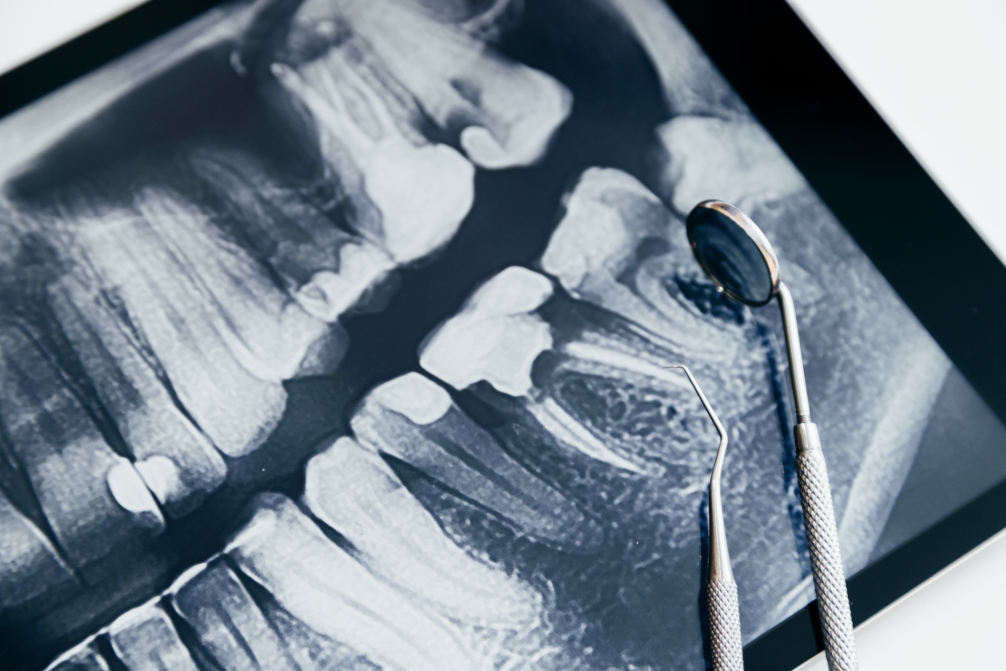 Dental instruments and jaw x-ray on white table. Panoramic digital jaw x-ray on tablet